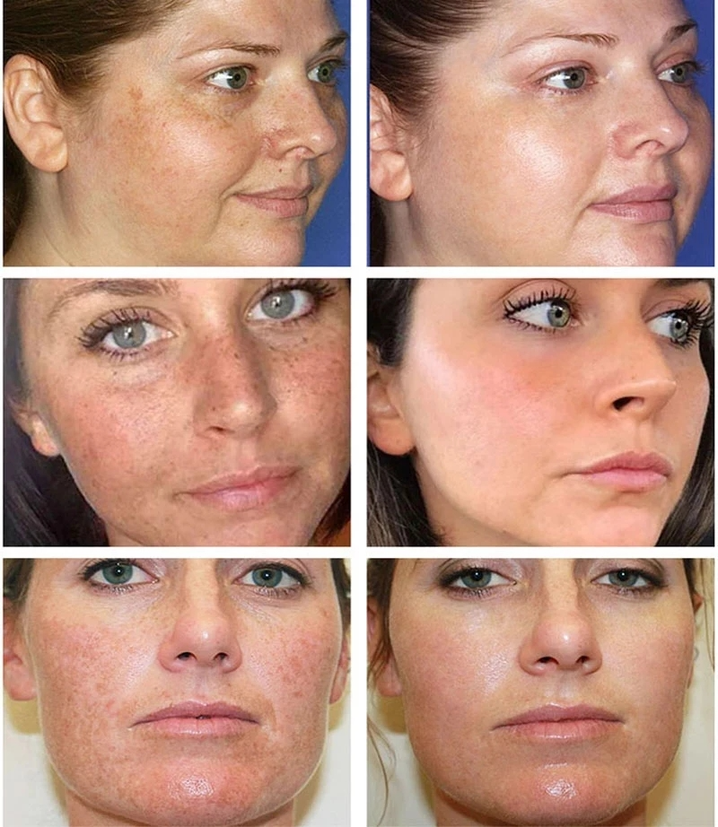 Light Cream - Creme Clareador de Manchas e Melasma