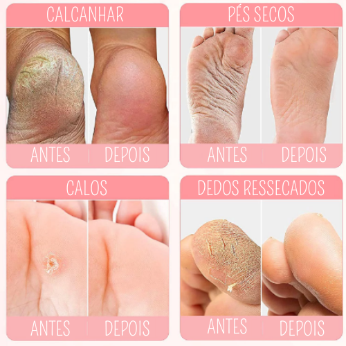 Máscara Peeling - Super Hidratação Para os Pés